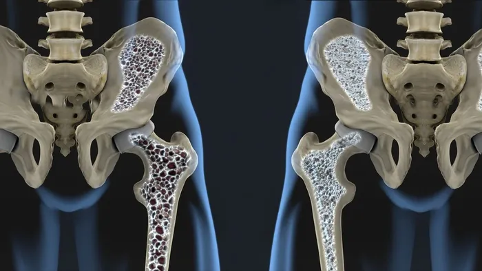 Osteoporosia: diagnostikoa eta tratamendua